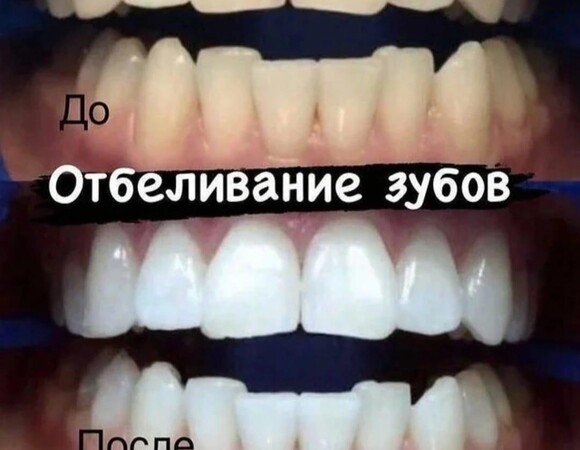 Отбеливание зубов